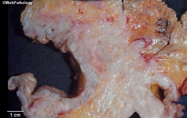 Pathology 521 i AdenoCarcinoma Colon Colorectal cancer Cauliflower  fungating polypoid napkin ring - YouTube