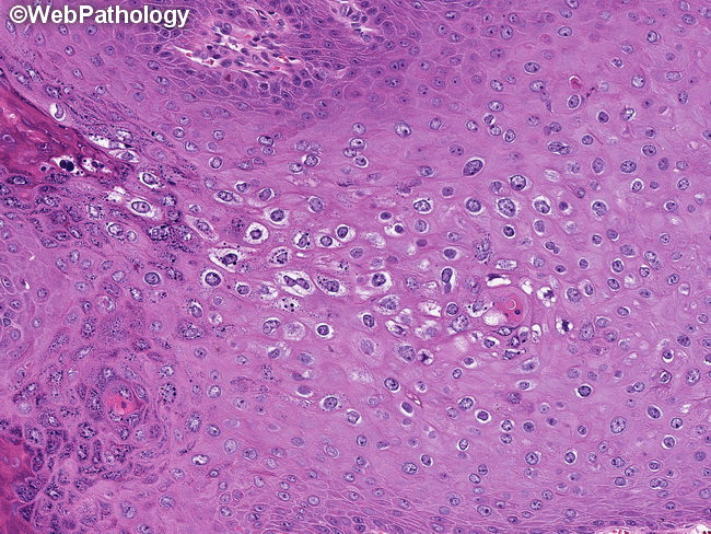 Condyloma acuminata pathology, Histopathology Skin--Squamous cell carcinoma cancer rectocolon