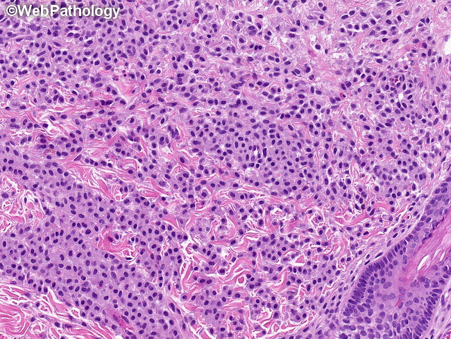 CutaneousMastocytosis12.jpg