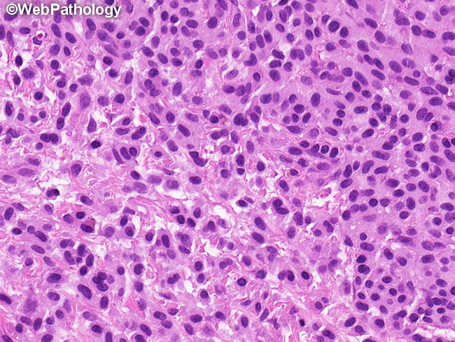 CutaneousMastocytosis13.jpg
