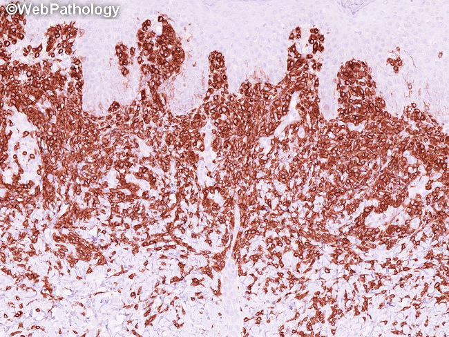 CutaneousMastocytosis19_CD117.jpg