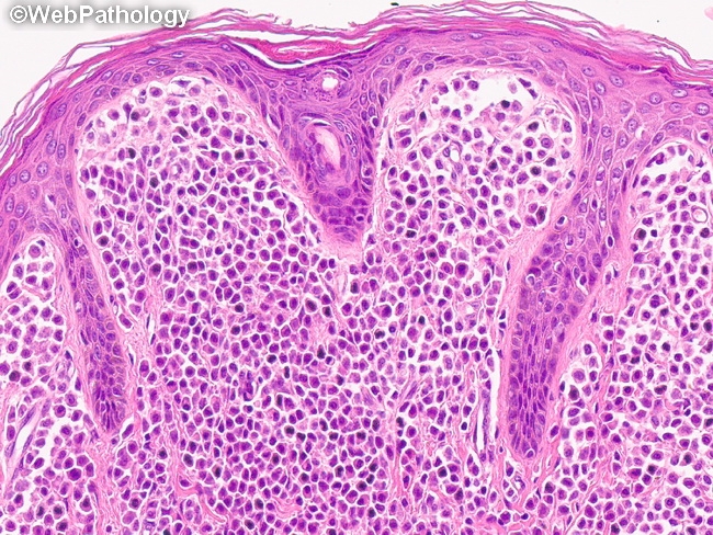 CutaneousMastocytosis22.jpg