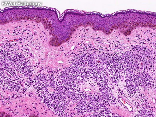 CutaneousMastocytosis3.jpg