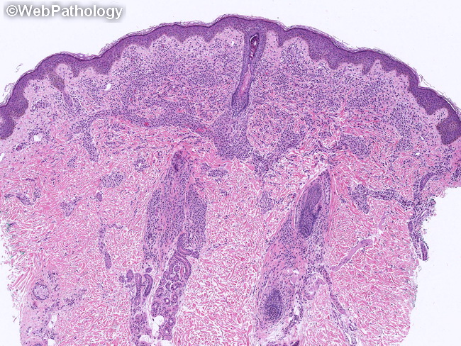 CutaneousMastocytosis6.jpg