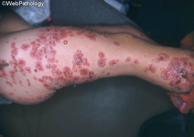 DermatitisHerpetiformis11.jpg
