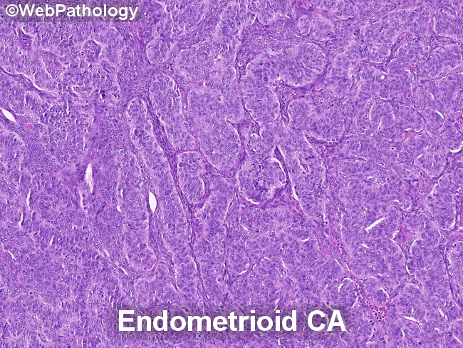 EndometrioidCA_Differential_AGCT_resized.jpg