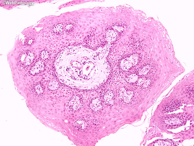 esophagus squamous papilloma dermatite cause