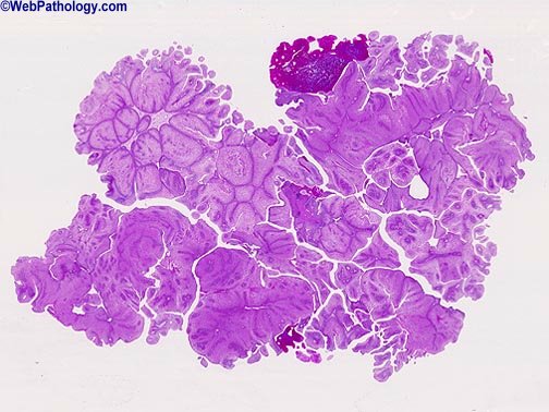 condyloma acuminatum pathology outlines cancer colon quimioterapia