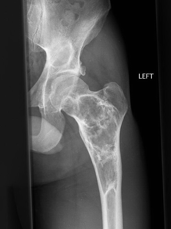 Fibrous Dysplasia : Radiology.