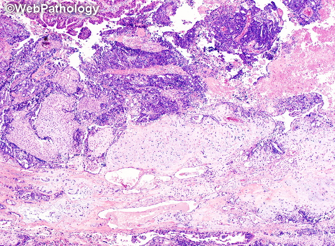 Gallbladder_Carcinosarcoma5.jpg