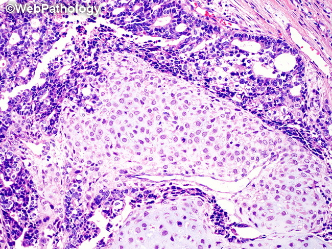 Gallbladder_Carcinosarcoma8.jpg