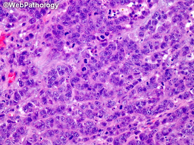 Gallbladder_Neoplastic_LargeNECarcinoma2.jpg