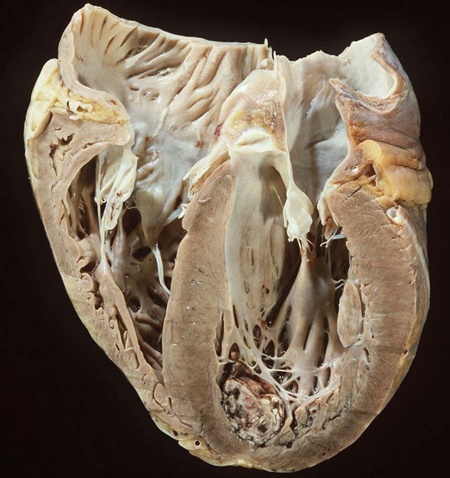 Heart_Cardiomyopathy6_Dilated_Resized.jpg
