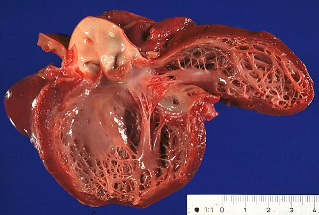 Heart_Cardiomyopathy_Anthracyclines_Resized.jpg