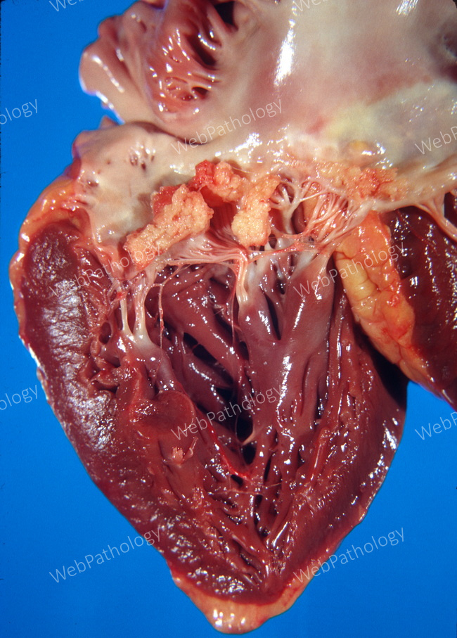 Heart_Endocarditis_NonBacterialThrombotic14_cropped.jpg