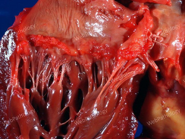 Heart_Endocarditis_NonBacterialThrombotic15_VerrucalEndocarditis_Mitral.jpg