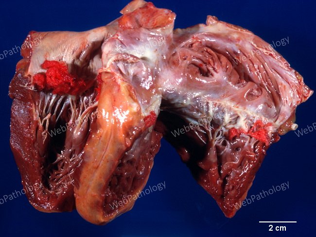 Heart_Endocarditis_NonBacterialThrombotic9B_TricuspidMitral.jpg