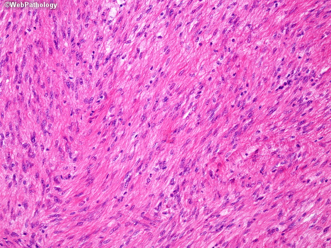 Heart_Tumors_Fibrosarcoma2.jpg