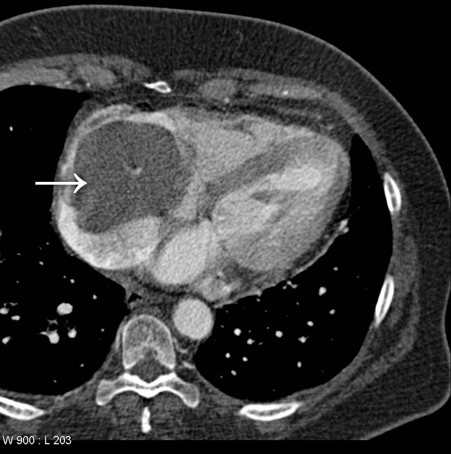 Heart_Tumors_Myxoma53_Radiology_Arrow.jpg