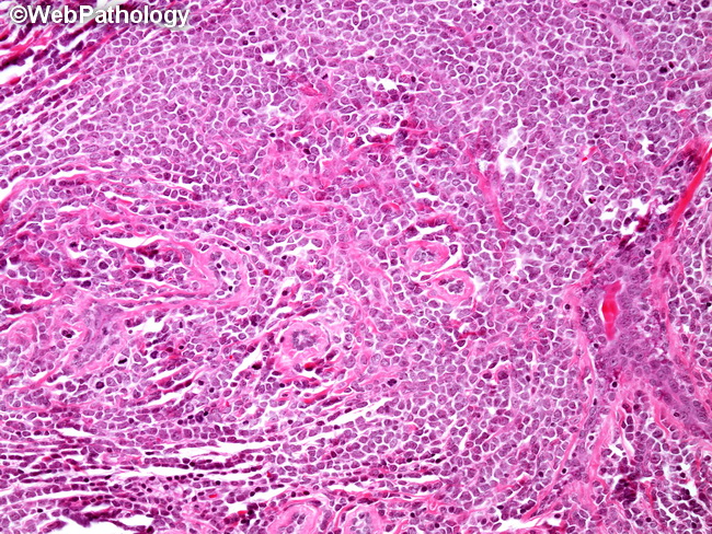 HemePath_GranulocyticSarcoma11_Breast.jpg