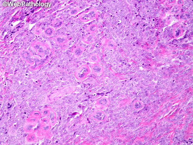 HemePath_GranulocyticSarcoma15_Breast.jpg