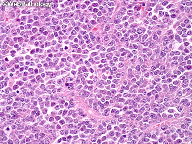 HemePath_GranulocyticSarcoma18_Ovary.jpg