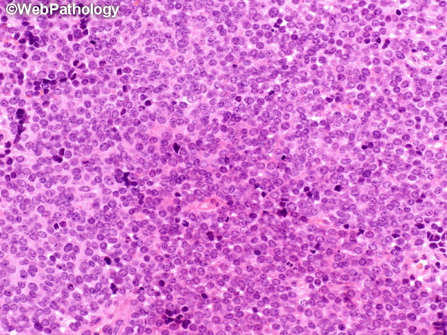 HemePath_GranulocyticSarcoma2_bladdermass.jpg