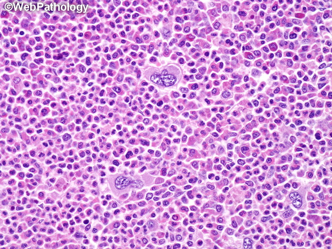 HemePath_GranulocyticSarcoma6_Bone.jpg