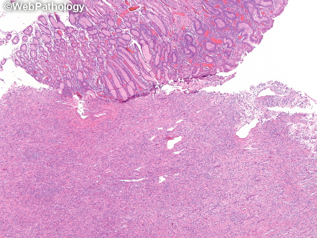 HemePath_HistiocyticSarcoma1.jpg
