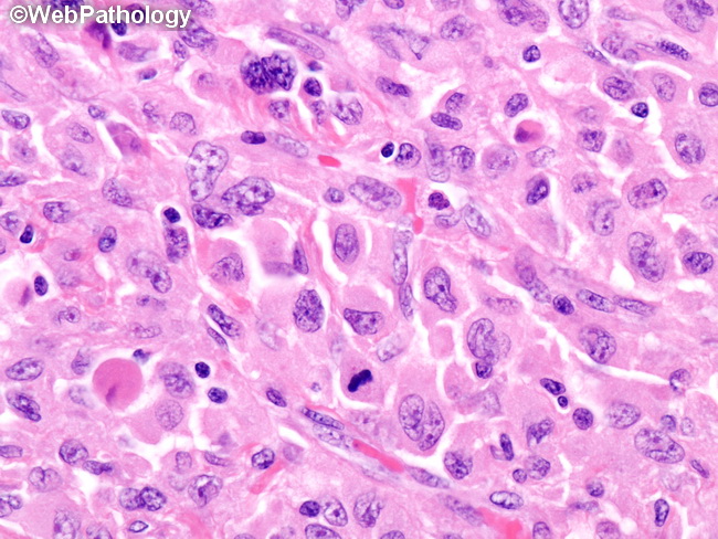 HemePath_HistiocyticSarcoma10.jpg