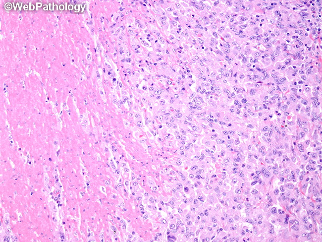 HemePath_HistiocyticSarcoma11.jpg