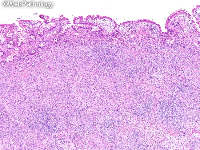 HemePath_HistiocyticSarcoma14.jpg