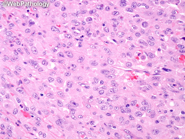 HemePath_HistiocyticSarcoma5.jpg