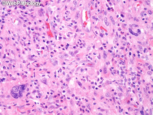 HemePath_HistiocyticSarcoma7.jpg