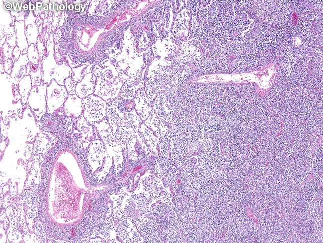 HemePath_LymphomatoidGranulomatosis2.jpg