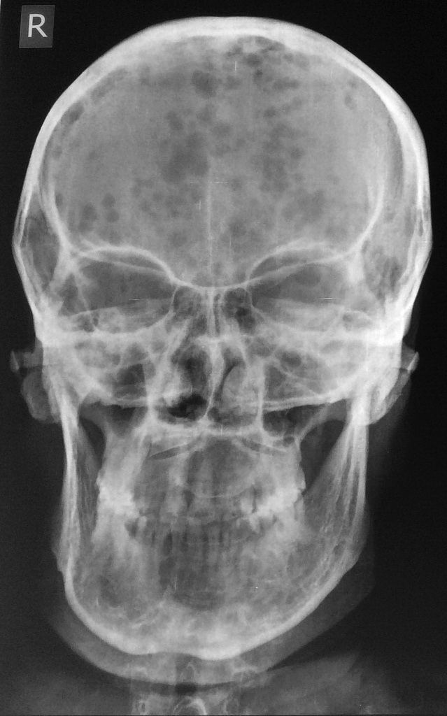 HemePath_MM_Radiology3_resized.jpg