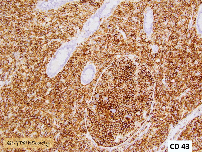 HemePath_MyeloidSarcoma_Immunos1_CD43_resized.jpg