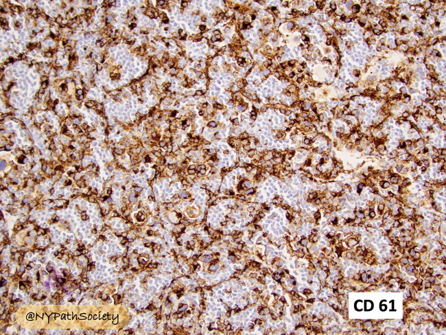 HemePath_MyeloidSarcoma_Immunos2_CD61_resized.jpg