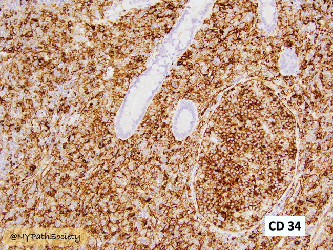 HemePath_MyeloidSarcoma_Immunos3_CD34_resized.jpg