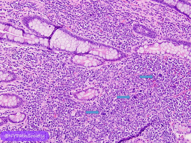 HemePath_MyeloidSarcoma_Megakaryocytic2_resized.jpg