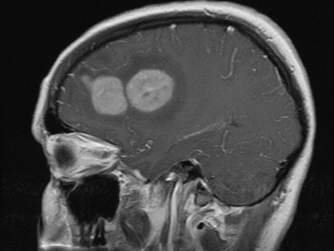 HemePath_MyeloidSarcoma_Radiology2_resized.jpg