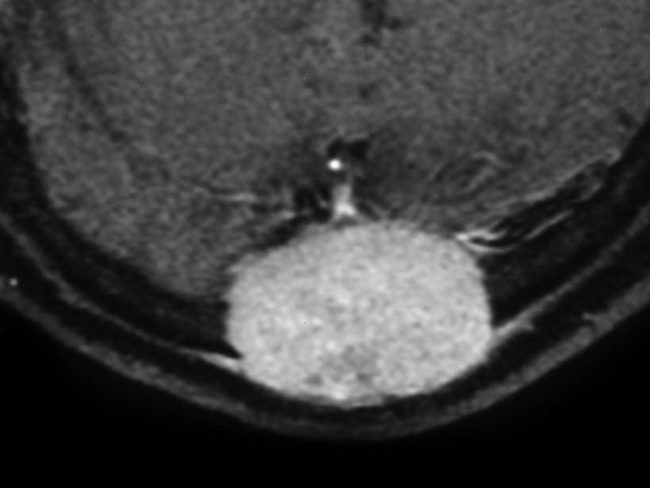 HemePath_MyeloidSarcoma_Radiology4_resized.jpg
