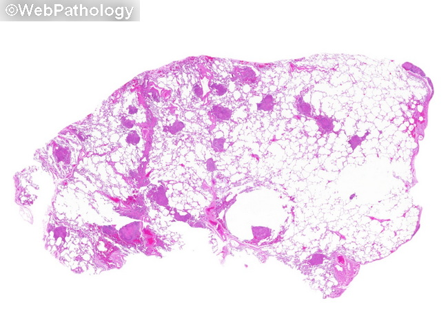 InfectiousDz_Coccidioidomycosis1_lung_resized.jpg