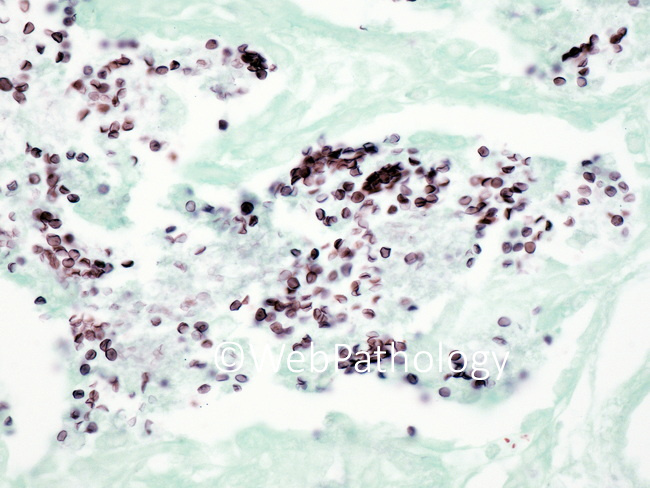 InfectiousDz_Fungi_Pneumocystis11_GMS.jpg
