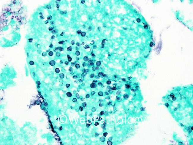 InfectiousDz_Fungi_Pneumocystis15_GMS_resized.jpg