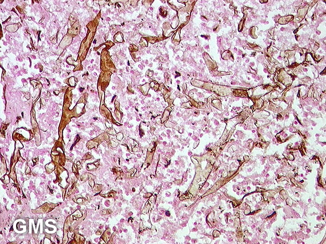 InfectiousDz_Stomach_Mucormycosis4_GMS.jpg