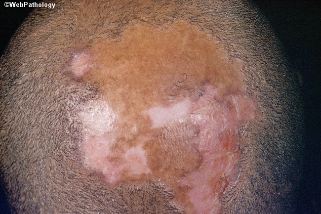 Inflamm_Lupus1_Alopecia.jpg