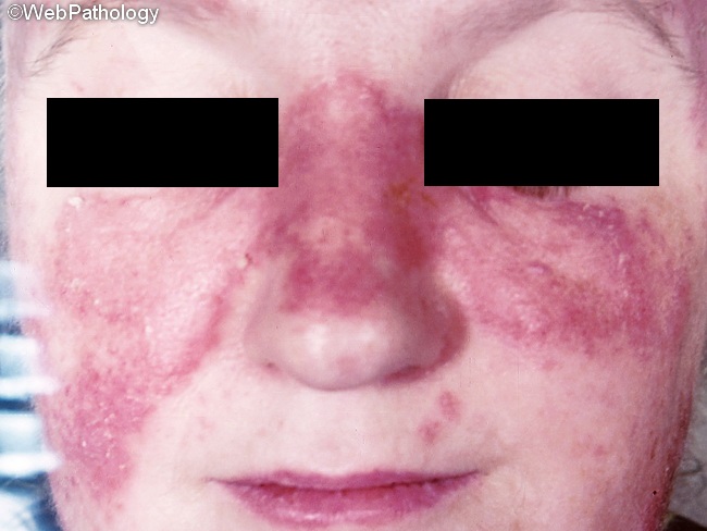 Inflamm_Lupus30_Discoid_cropped.jpg
