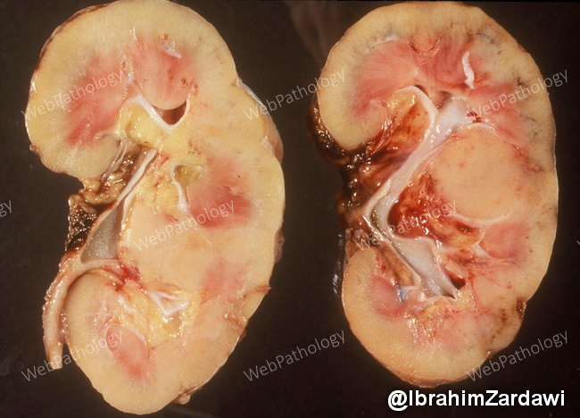 Kidney_Amyloidosis1_Zardawi_resized.jpg