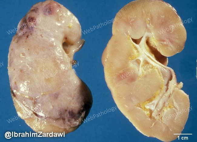 Kidney_Amyloidosis2_Zardawi_resized.jpg